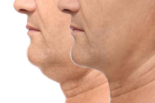 HIFU - Breakthrough in Anti - ageing 2 hifu results Waltham Abbey
