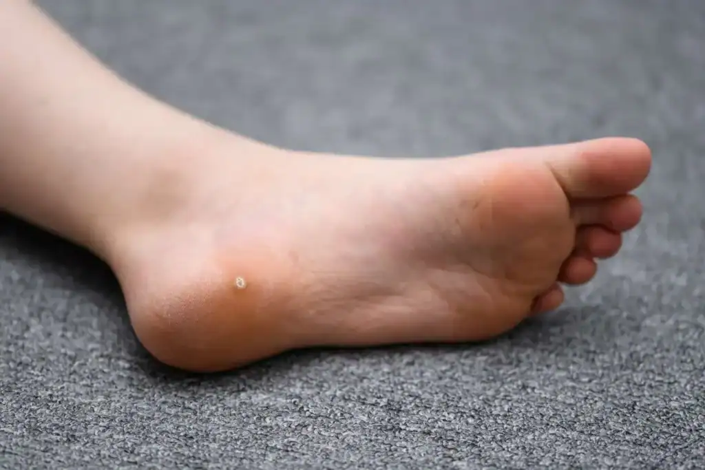 Cryotherapy For Warts And Also Verrucas 2 Image of verruca on the bottom of the foot that able to be treated with Cryotherapy Waltham Abbey