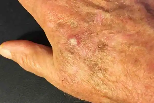 Cryopen For Actinic Keratoses 1 Image of Actinic keratoses Waltham Abbey on a person hand