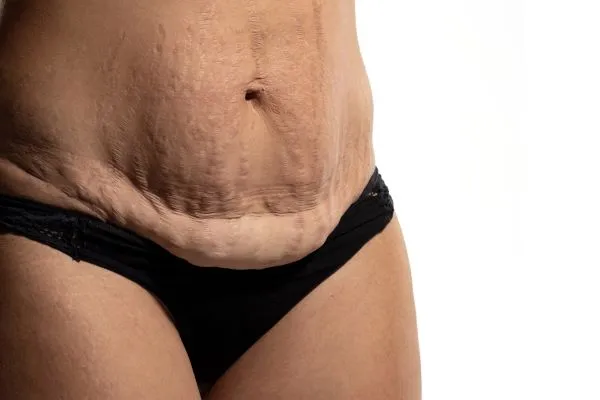 The science behind skin tightening Waltham Abbey picture of a woman's sagging skin on the stomach